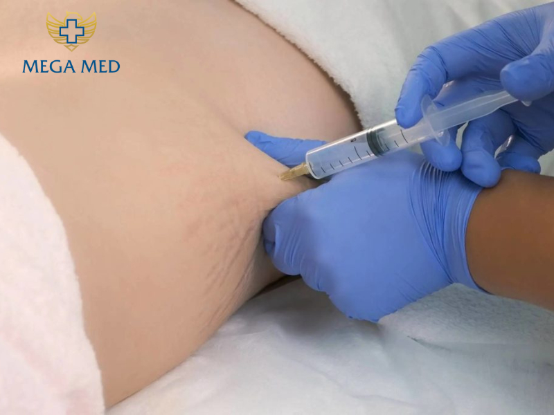 phẫu thuật kéo dài cậu nhỏ